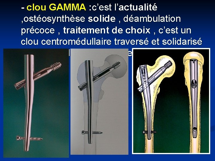 - clou GAMMA : c’est l’actualité , ostéosynthèse solide , déambulation précoce , traitement