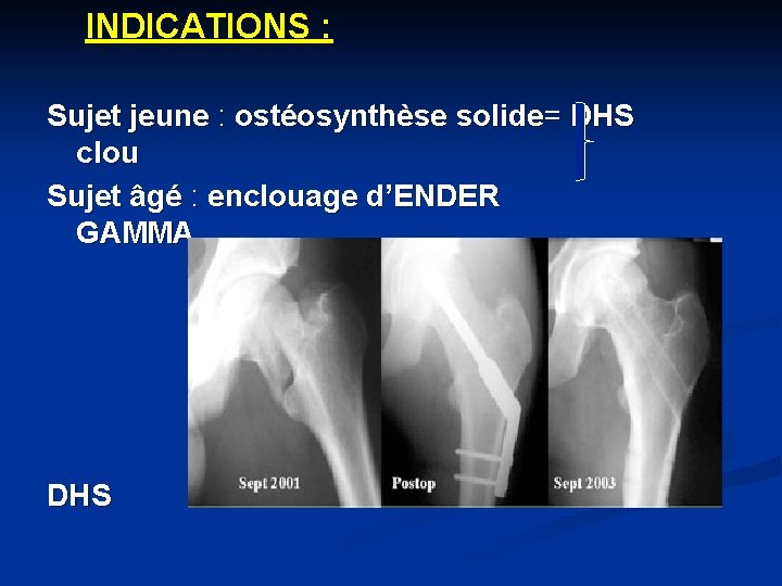 INDICATIONS : Sujet jeune : ostéosynthèse solide= DHS clou Sujet âgé : enclouage d’ENDER
