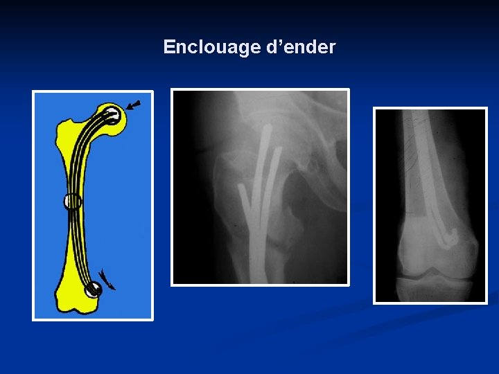 Enclouage d’ender 