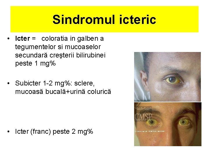 Sindromul icteric • Icter = coloratia in galben a tegumentelor si mucoaselor secundară creşterii