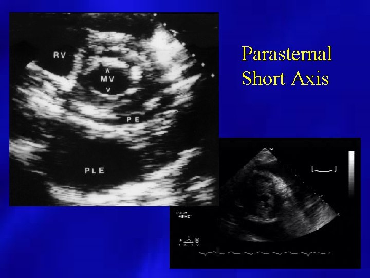 Parasternal Short Axis 