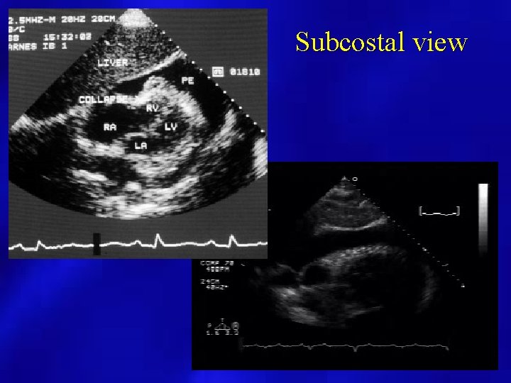 Subcostal view 