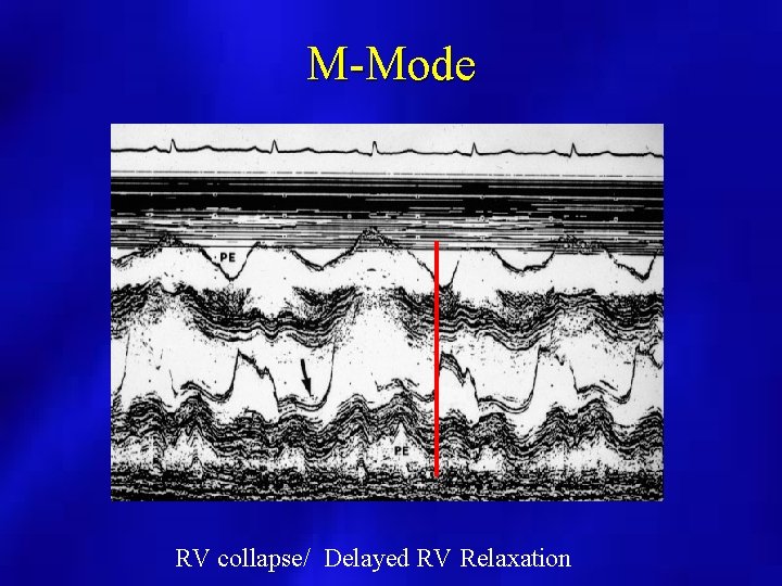 M-Mode RV collapse/ Delayed RV Relaxation 