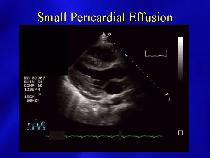 Small Pericardial Effusion 