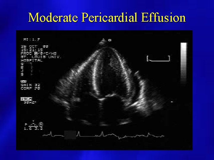 Moderate Pericardial Effusion 
