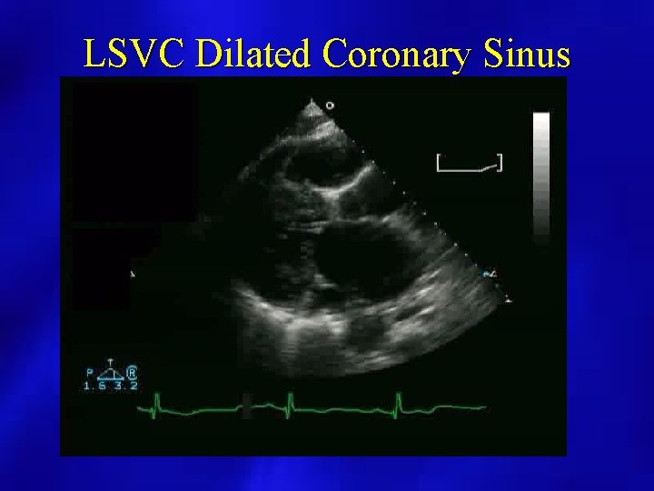 LSVC Dilated Coronary Sinus 