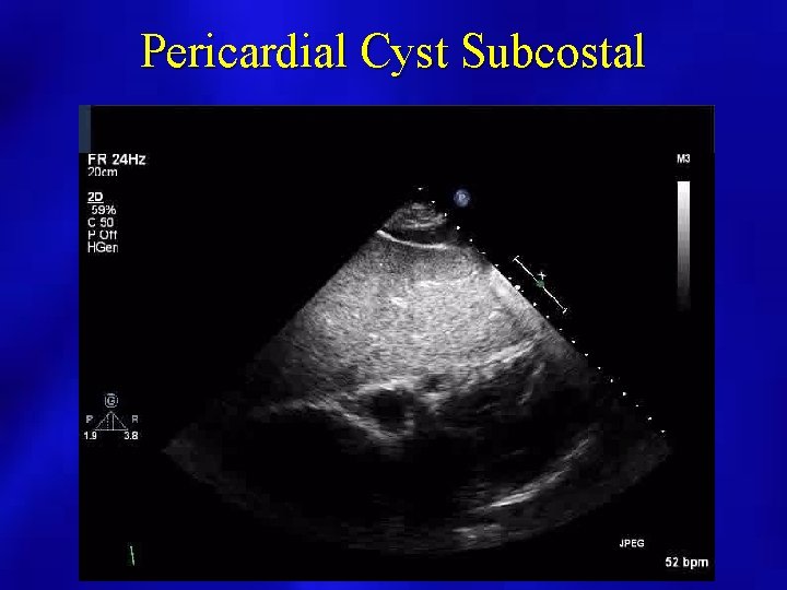 Pericardial Cyst Subcostal 