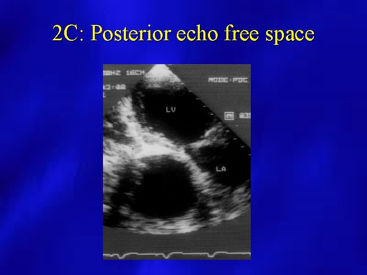 2 C: Posterior echo free space 