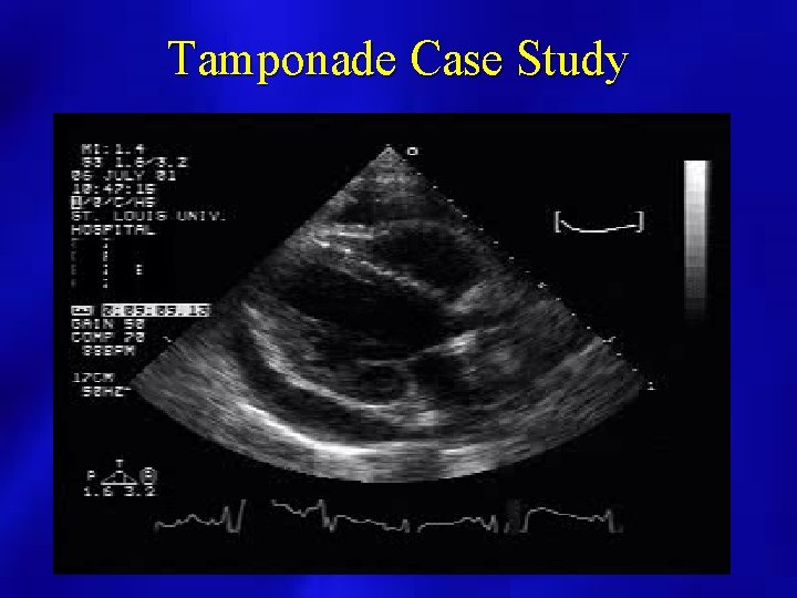Tamponade Case Study 