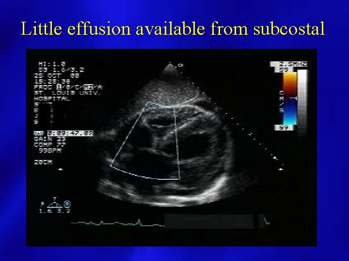 Little effusion available from subcostal 