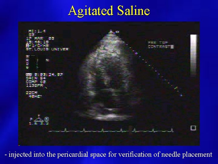Agitated Saline - injected into the pericardial space for verification of needle placement 