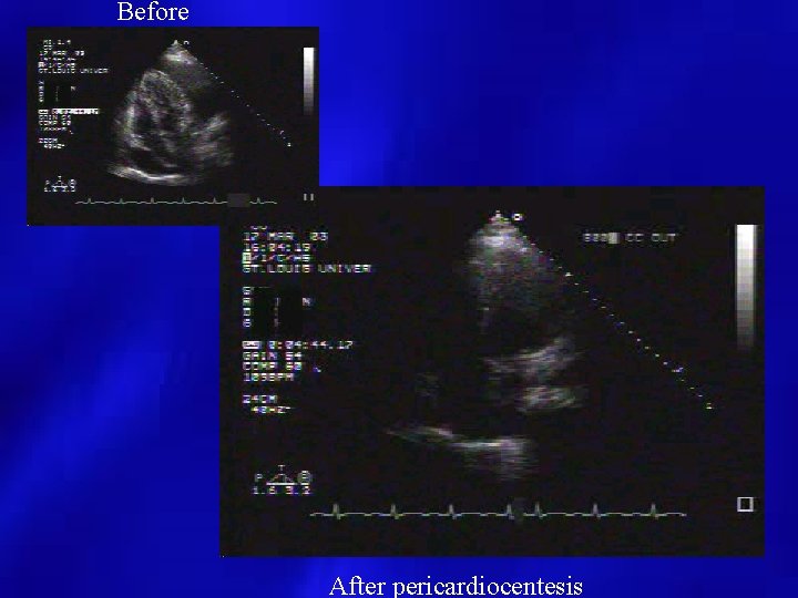 Before After pericardiocentesis 