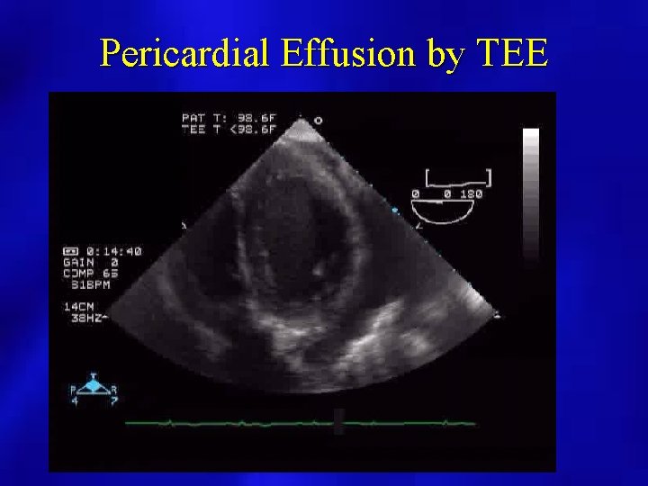 Pericardial Effusion by TEE 