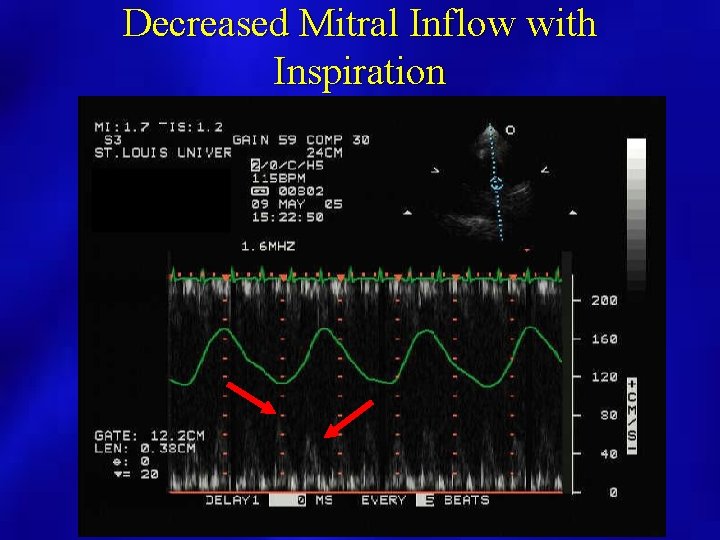 Decreased Mitral Inflow with Inspiration 