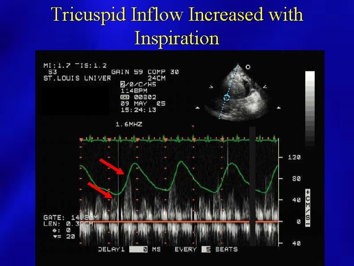 Tricuspid Inflow Increased with Inspiration 