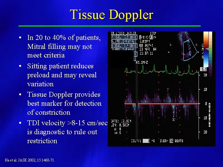 Tissue Doppler • In 20 to 40% of patients, Mitral filling may not meet