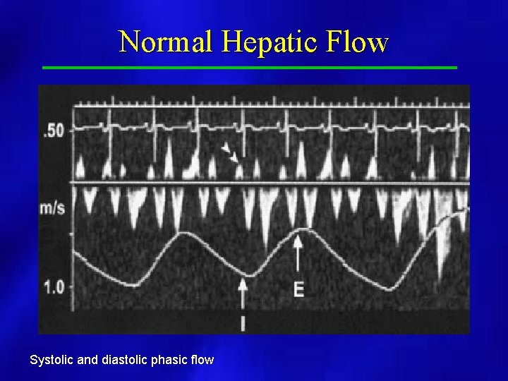 Normal Hepatic Flow Systolic and diastolic phasic flow 