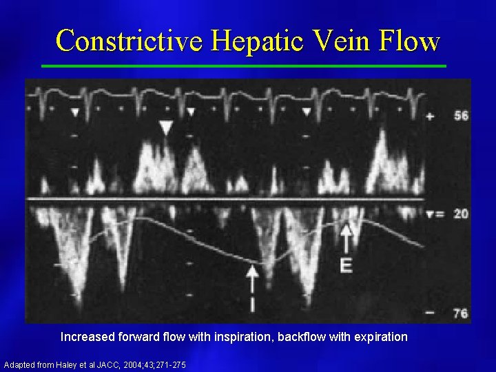 Constrictive Hepatic Vein Flow Increased forward flow with inspiration, backflow with expiration Adapted from