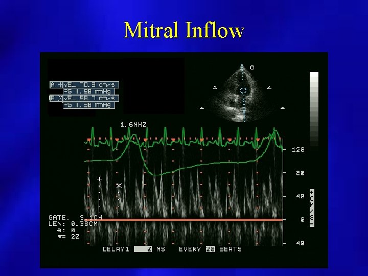 Mitral Inflow 