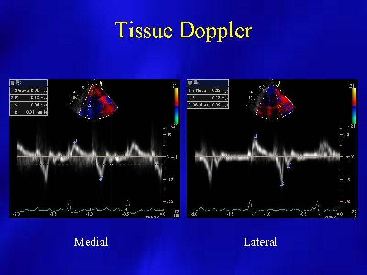 Tissue Doppler Medial Lateral 