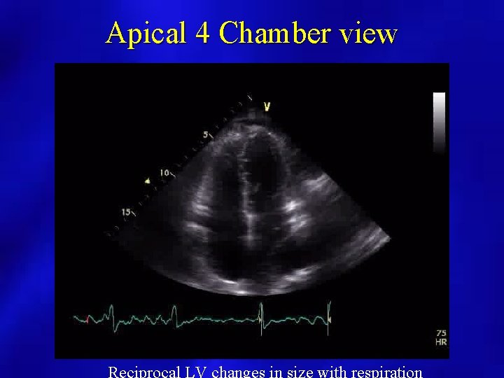 Apical 4 Chamber view 