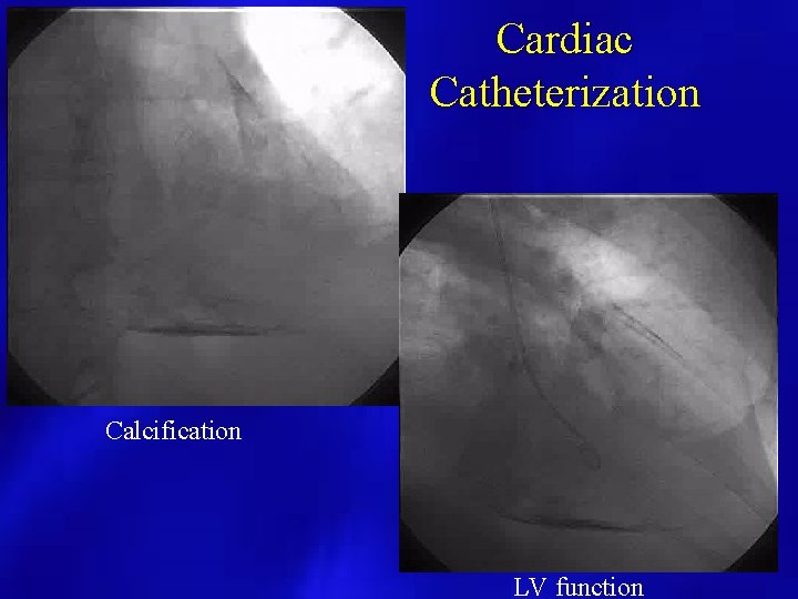 Cardiac Catheterization Calcification LV function 