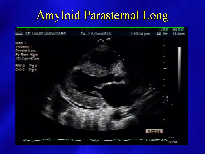 Amyloid Parasternal Long 