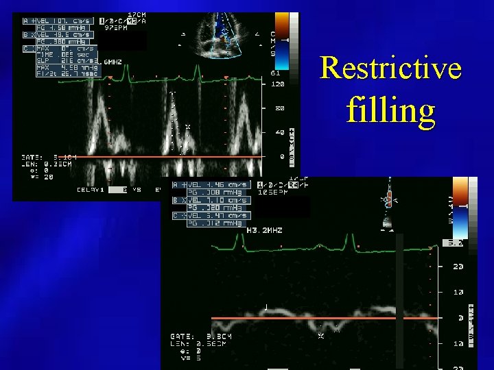 Restrictive filling 