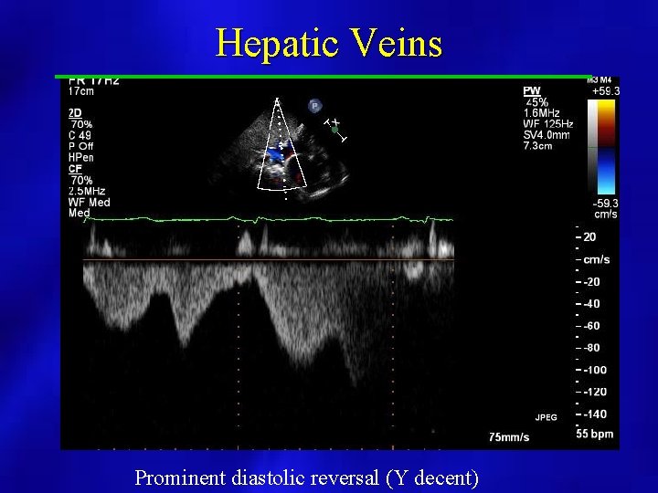 Hepatic Veins Prominent diastolic reversal (Y decent) 