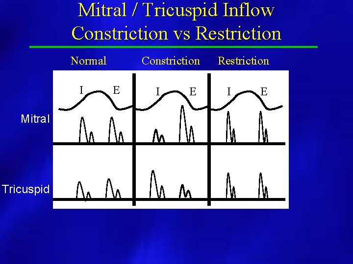 Mitral / Tricuspid Inflow Constriction vs Restriction Normal I Mitral Tricuspid Constriction E I