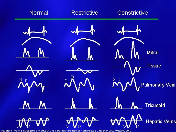 Normal Restrictive Constrictive Mitral Tissue S D S D Pulmonary Vein Tricuspid S D