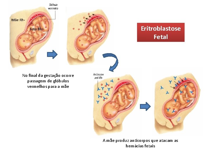 Eritroblastose Fetal No final da gestação ocorre passagem de glóbulos vermelhos para a mãe