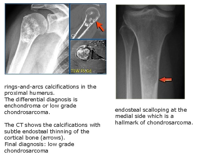 rings-and-arcs calcifications in the proximal humerus. The differential diagnosis is enchondroma or low grade