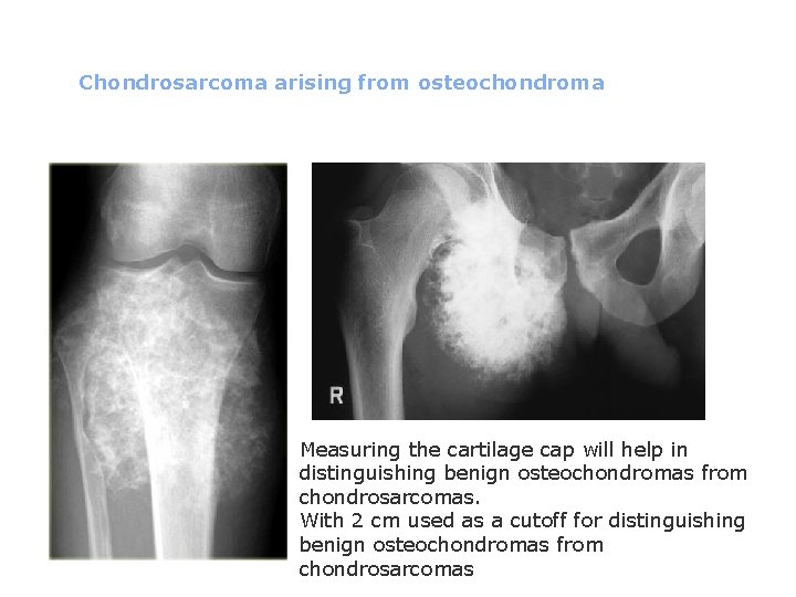 Chondrosarcoma arising from osteochondroma Measuring the cartilage cap will help in distinguishing benign osteochondromas