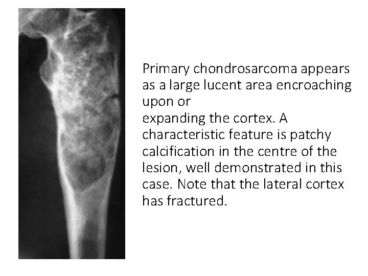 Primary chondrosarcoma appears as a large lucent area encroaching upon or expanding the cortex.