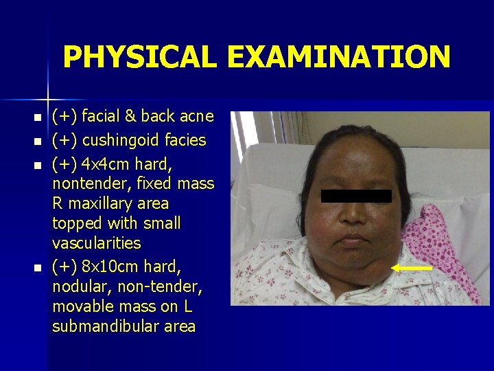 PHYSICAL EXAMINATION n n (+) facial & back acne (+) cushingoid facies (+) 4
