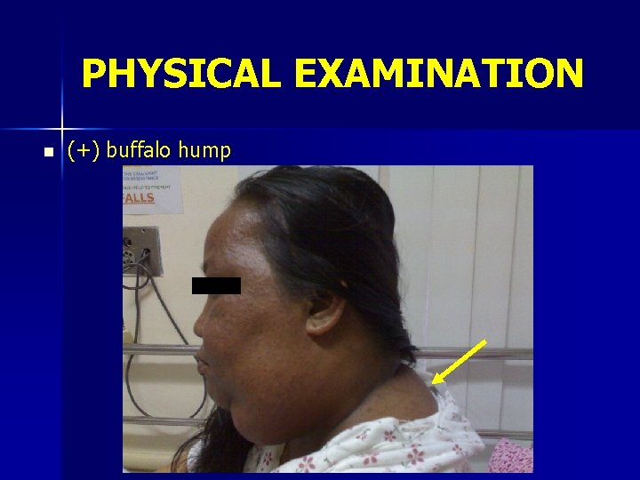 PHYSICAL EXAMINATION n (+) buffalo hump 