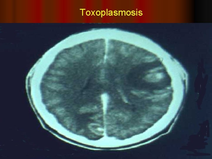 Toxoplasmosis 