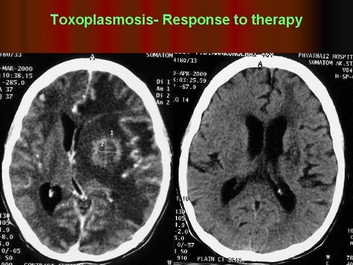 Toxoplasmosis- Response to therapy 