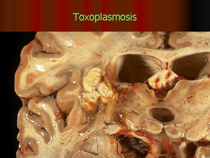 Toxoplasmosis 