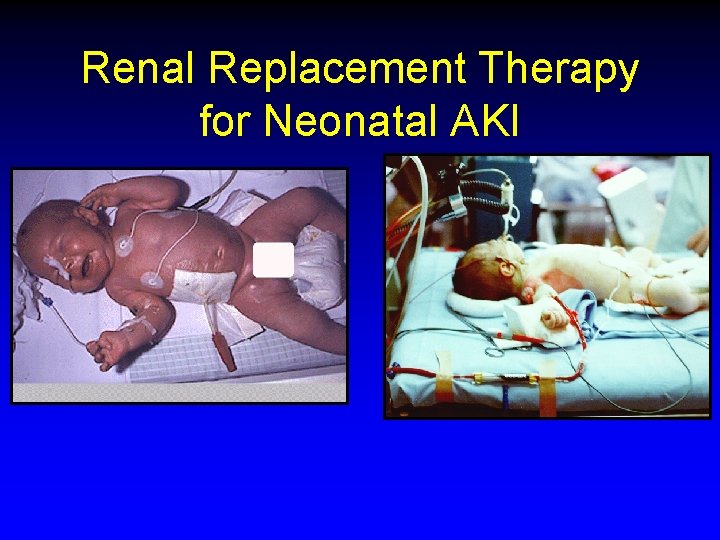 Renal Replacement Therapy for Neonatal AKI 