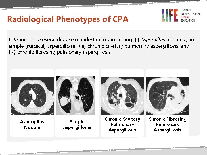 Radiological Phenotypes of CPA includes several disease manifestations, including (i) Aspergillus nodules , (ii)