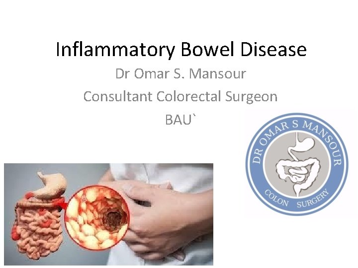 Inflammatory Bowel Disease Dr Omar S. Mansour Consultant Colorectal Surgeon BAU` 