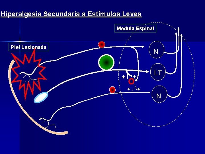 Hiperalgesia Secundaria a Estímulos Leves Medula Espinal Piel Lesionada N + LT + +