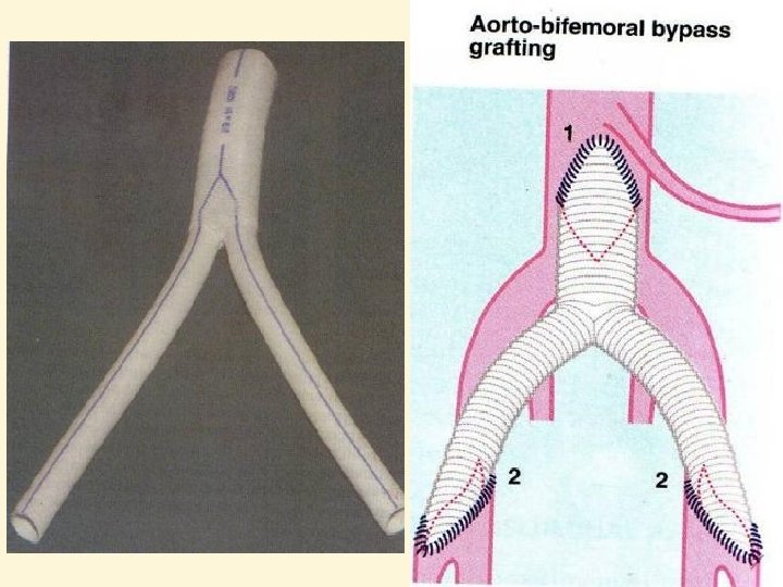 Pathophysiology of atherosclerosis A Normal arterial wall The