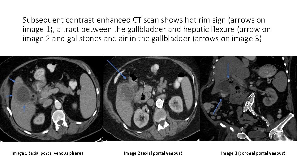 Subsequent contrast enhanced CT scan shows hot rim sign (arrows on image 1), a