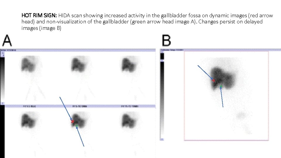 HOT RIM SIGN: HIDA scan showing increased activity in the gallbladder fossa on dynamic