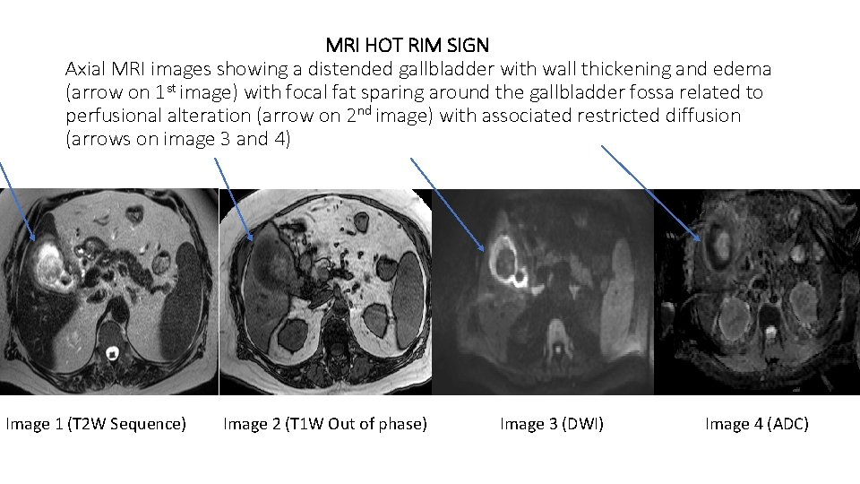 MRI HOT RIM SIGN Axial MRI images showing a distended gallbladder with wall thickening