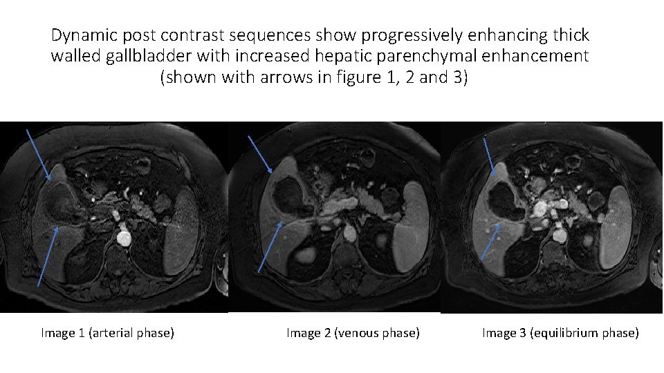 Dynamic post contrast sequences show progressively enhancing thick walled gallbladder with increased hepatic parenchymal