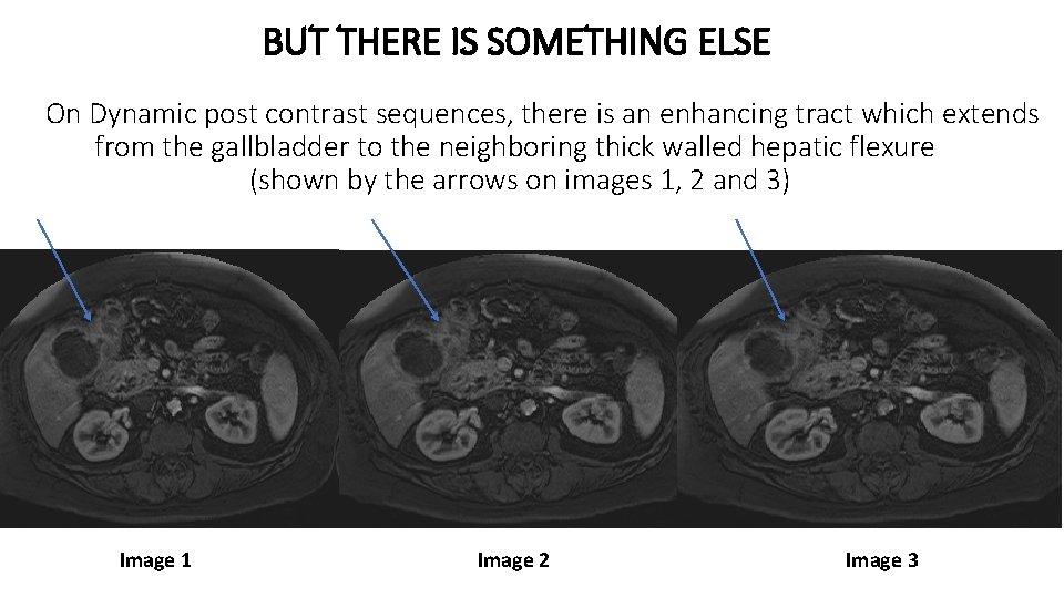 BUT THERE IS SOMETHING ELSE On Dynamic post contrast sequences, there is an enhancing